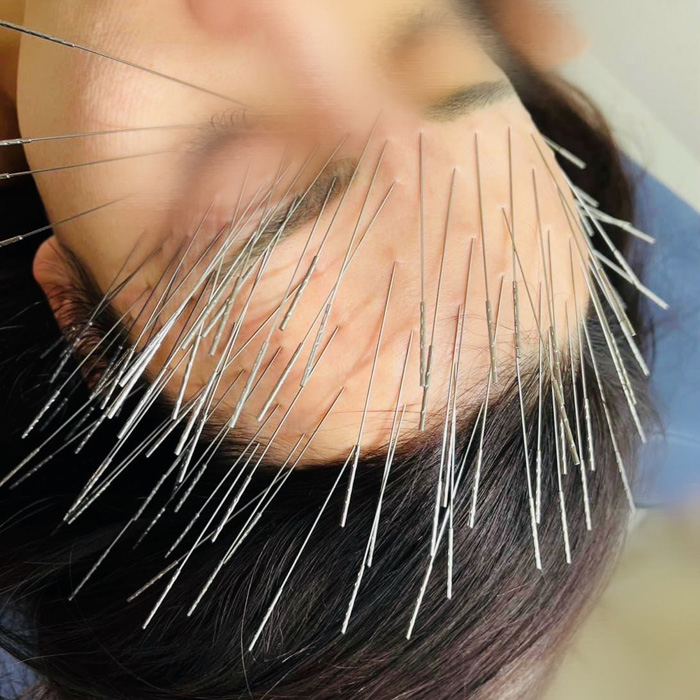 ルート治療中画像